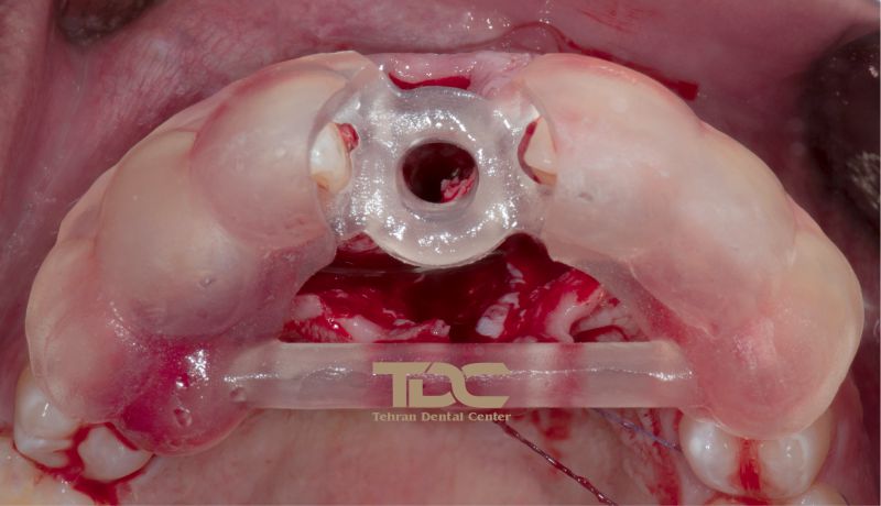 بهترین ایمپلنت تهران